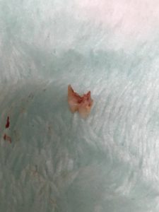 歯が…抜けた…